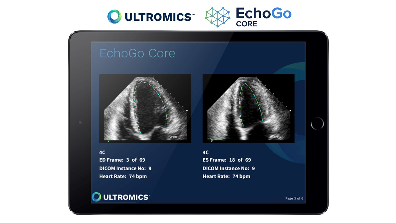 Q&A: The value of strain for echocardiography - Ultromics