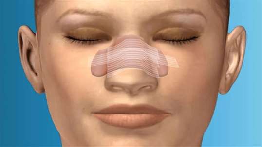 Virtual Nose Surgery screenshot 2