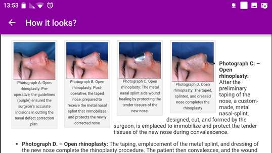 Nose job - Rhinoplasty plastic surgery screenshot 2