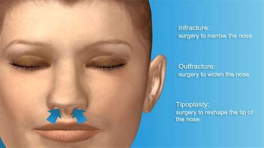 Virtual Nose Surgery screenshot 4