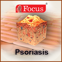 Psoriasis - An Overview