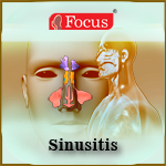 Sinusitis - An Overview
