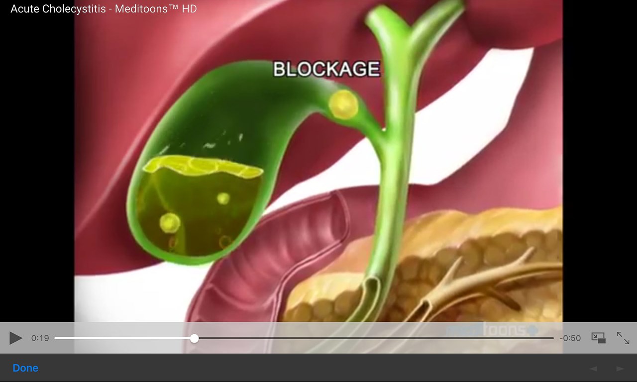 Липазы жкт. Холангиокарцинома клацкина. Панкреатическая эластаза кала. Желчный врачу идти. Желчный врачу идти.