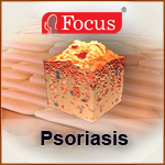 Psoriasis - An Overview